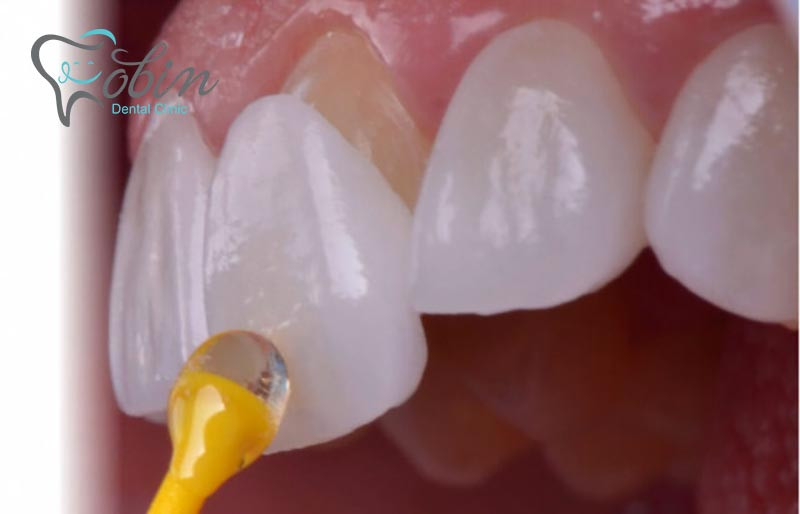 لمینیت سطح دندان های طبیعی شما را می پوشاند.